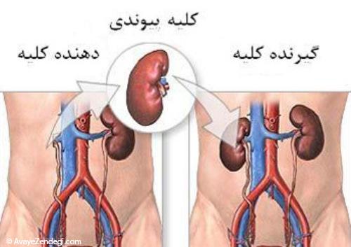 بیماری مزمن کلیه و درمان آن 