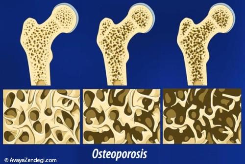 پوکی استخوان و تأثیر ورزش بر آن 
