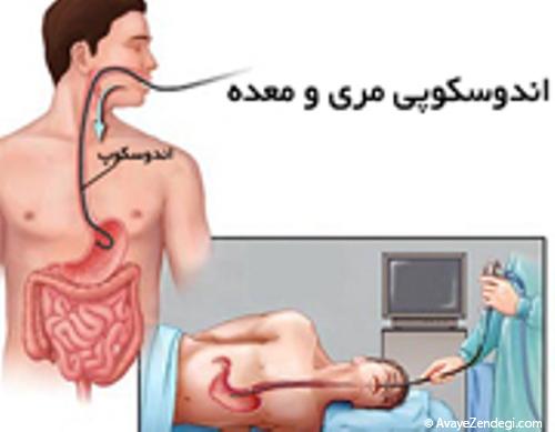 عضلات مری هم می گیرند