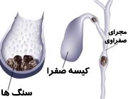  نشانه های مشکلات کیسه صفرا 