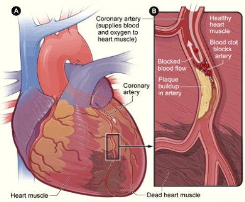  بیماری ایسکمیک قلبی، علل و درمان 