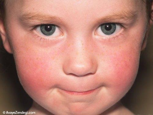  بیماری های پوستی شایع در کودکان 