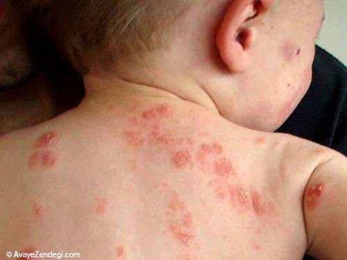  بیماری های پوستی شایع در کودکان 