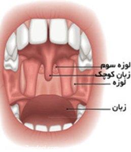  لوزه سوم؛ درمان دارویی یا جراحی؟ 