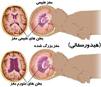 در هیدروسفالی، سر بزرگ می شود