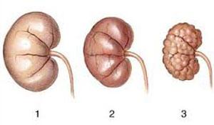  نارسایی کلیه را بشناسیم 