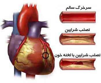 تصلب شرایین چیست ؟