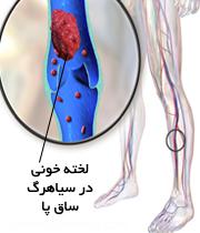 جلوی لخته شدن خون را بگیریم 