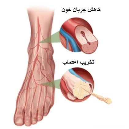  چسب جدید برای زخم پای دیابتی 