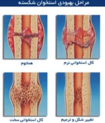 چطور استخوان شکسته جوش می خورد؟