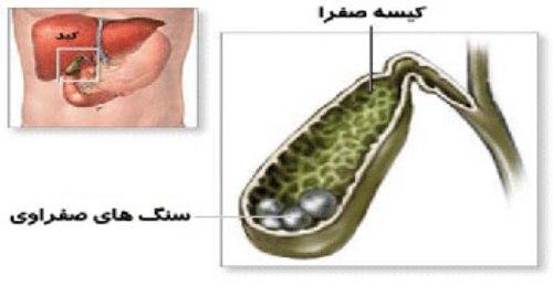 راههای پیشگیری از تشکیل سنگ صفرا