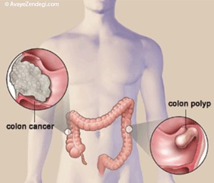 5 راه ساده برای پیشگیری از سرطان روده بزرگ