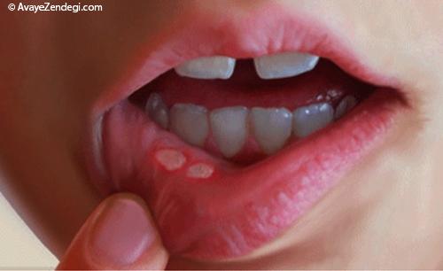5 نشانه جدی در دهان