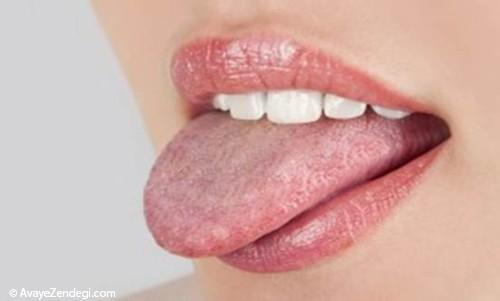 درمان برفک دهان در طب سنتی