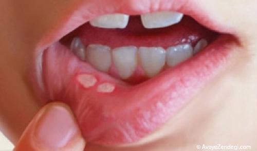 بیماری های دهان و درمان آن با طب سنتی